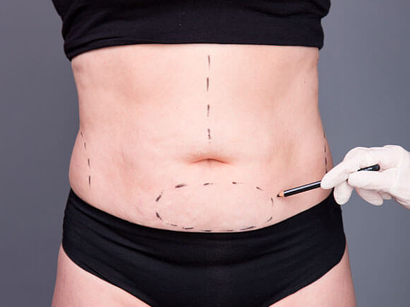 Abdominoplastia