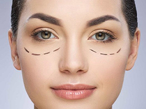 Blefaroplastia