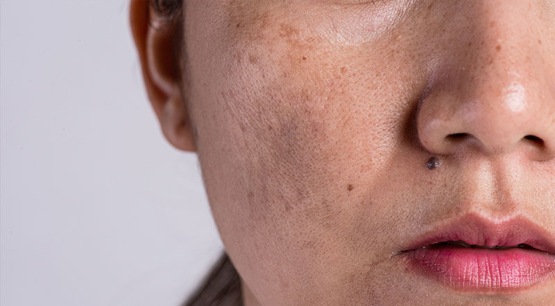 Tratamento para manchas e melasma